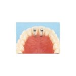 KIT DIASTEMAS/RECAMBIOS - tubos y 10 resortes - Kit