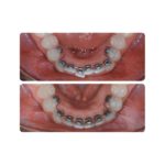 BRACKETS LINGUALES IDEA-L/KIT BRACKETS LINGUALES IDEA-L - 5 Brackets - 11, 12, 13, 21, 22, 23, 31, 32, 33, 41, 42, 43