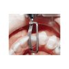 LIMAS ORTHO STRIPS ONE-SIDED/DOUBLE SIDED/GRANOS/OPENERS - 3-piezas - izquierda